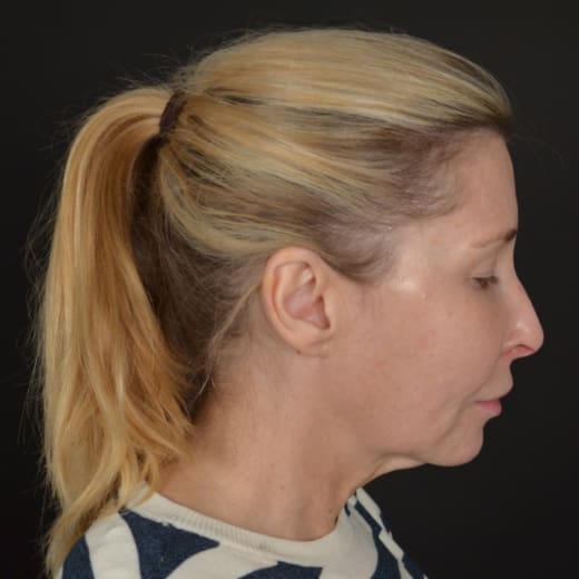 Before a deep plane face and neck lift.