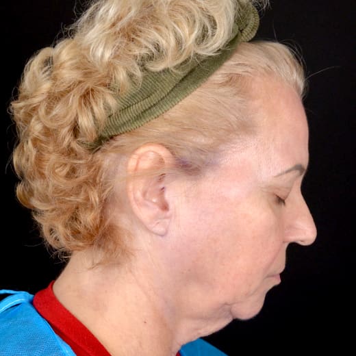 Before deep plane facelift and jowl lift and upper eyelid surgery, and volume restoring injections and sagging neck