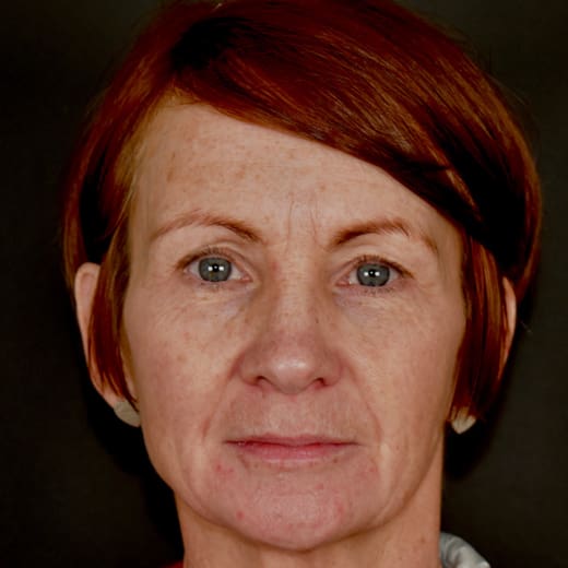 Before full facelift and deep plane face and neck lift with Halo laser treatment