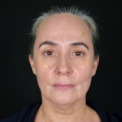 Before a full facelift with deep plane face and neck lift and jowl lift, addressing sagging neck, sagging jawline, and jowls