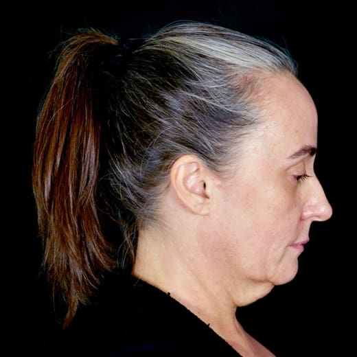 Before a full facelift with deep plane face and neck lift and jowl lift, addressing sagging neck, sagging jawline, and jowls