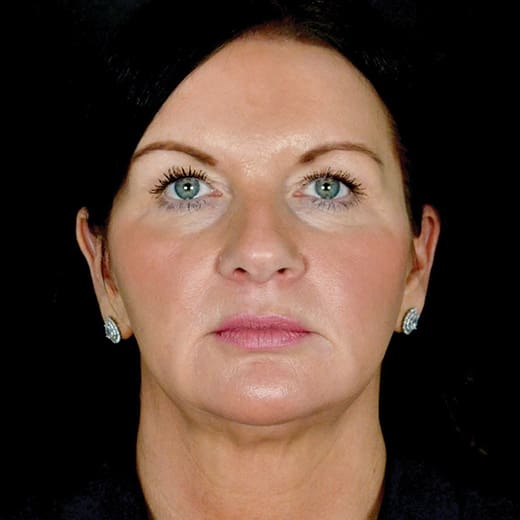 Before a full facelift, deep plane face and neck lift, liposuction under the chin, and upper eyelid surgery.
