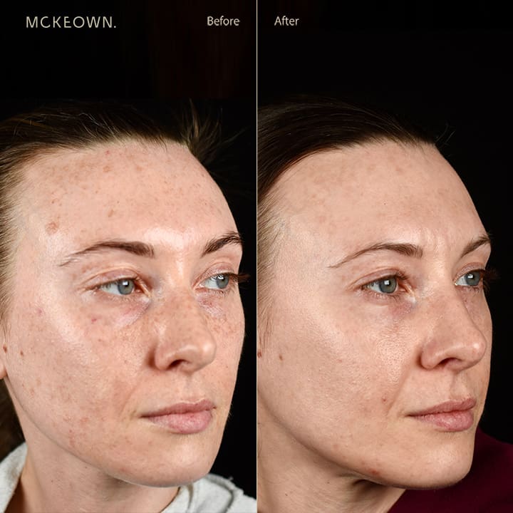 Before and after results of BBL and Halo treatments, addressing sun damage and age spots.