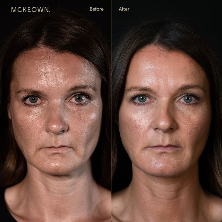 Before and after results of a volumetric facelift with chin and jaw filler, addressing downturned mouth corners