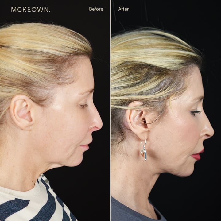 Full Facelift Deep Plane Face And Neck Lift Before And After