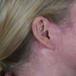 After laser treatment to address scarring