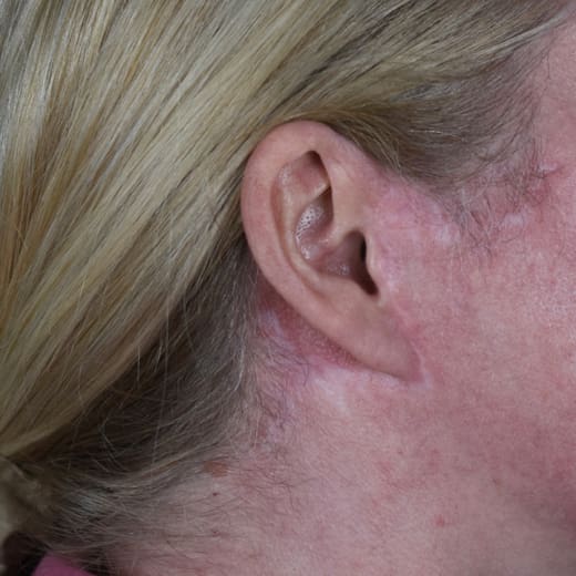 After laser treatment to address scarring