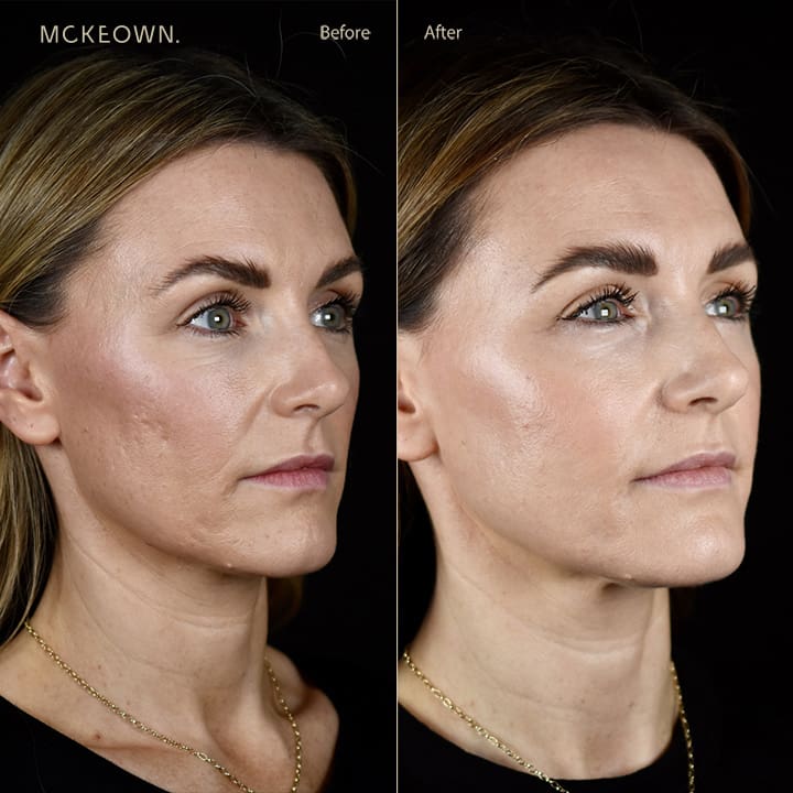 Before and after results of ProFractional treatment, addressing acne scars