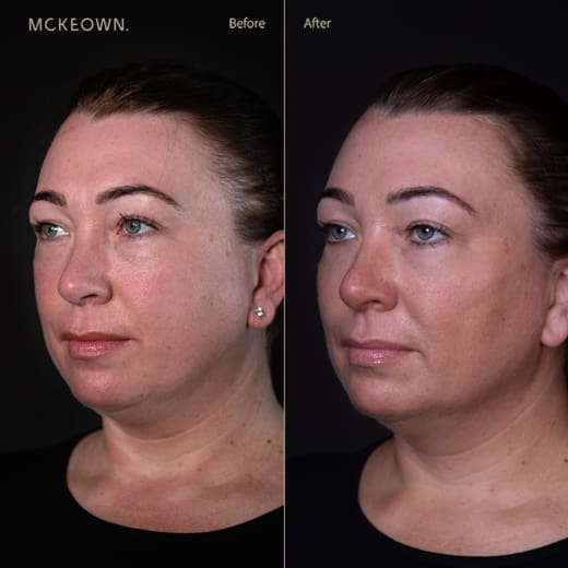 Before-and-after-cheek-filler-wrinkle-relaxing-injections-sagging-cheeks-frown-lines