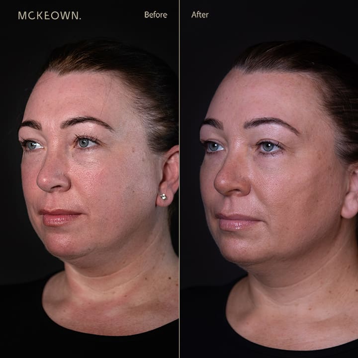 New project Today Yesterday Previous 7 Days Previous 30 Days April March View plans Unlimited access, team features, and more You said: I need to you to remove the dashes and put spaces in their place, as well as making the first letter a capital for every file name I put in this chat ChatGPT said: Got it! Just send over the file names, and I’ll format them by: Replacing dashes with spaces Capitalizing the first letter of each word Ready when you are! You said: full-facelift-deep-plane-face-and-neck-lift-before-and-after-r-pt106 ChatGPT said: Full Facelift Deep Plane Face And Neck Lift Before And After R Pt106 You said: Before-and-after-full-facelift-deep-plane-face-and-neck-lift-halo-laser-freckles ChatGPT said: Before And After Full Facelift Deep Plane Face And Neck Lift Halo Laser Freckles You said: before-and-after-volumetric-facelift-chin-jaw-filler-downturned-mouth-corners-f-pt10 ChatGPT said: Before And After Volumetric Facelift Chin Jaw Filler Downturned Mouth Corners F Pt10 You said: I'm using this as alt text - do you think it could be better ChatGPT said: Yes — alt text should be descriptive and helpful for accessibility, ideally conveying what someone would see in the image without being overly wordy. Your current version is clear, but we could make it a bit more natural and informative. Here’s an improved version: "Before and after results of a volumetric facelift with chin and jaw filler, addressing downturned mouth corners (female patient 10)." Would you like me to refine the others for alt text too? You said: Just use that format going forward ChatGPT said: Updated saved memory Perfect — I’ll use that format from now on. Just send the next filename when you're ready! You said: Before-and-after-volumetric-facelift-cheek-chin-jawline-filler-jowls-lo-pt5.jpg ChatGPT said: Before and after results of a volumetric facelift with cheek, chin, and jawline filler, addressing jowls (female patient 5). You said: Before-and-after-deep-plane-face-and-neck-lift-jowl-lift-jowls-sagging-neck-sagging-jawline-ro-pt41.jpg ChatGPT said: Before and after results of a deep plane face and neck lift with jowl lift, addressing jowls, sagging neck, and sagging jawline (female patient 41). You said: Before-and-after-volumetric-facelift-jowl-lift-chin-jaw-cheek-filler-sagging-cheeks-sagging-jawline-pt9-r ChatGPT said: Before and after results of a volumetric facelift with jowl lift and chin, jaw, and cheek filler, addressing sagging cheeks and sagging jawline (female patient 9). You said: Before-and-after-volumetric-facelift-cheek-chin-jawline-filler-jowls-f-pt5 ChatGPT said: Before and after results of a volumetric facelift with cheek, chin, and jawline filler, addressing jowls (female patient 5). You said: Before-and-after-volumetric-facelift-jowl-lift-chin-augmentation-tear-trough-filler-sagging-jawline-jowls-under-eye-bags-dark-circles-pt11-lo.jpg ChatGPT said: Before and after results of a volumetric facelift with jowl lift, chin augmentation, and tear trough filler, addressing sagging jawline, jowls, under-eye bags, and dark circles (patient 11). You said: Before-and-after-full-facelift-deep-plane-face-and-neck-lift-jowl-lift-sagging-neck-sagging-jawline-jowls-pt42-r.jpg ChatGPT said: Before and after results of a full facelift with deep plane face and neck lift and jowl lift, addressing sagging neck, sagging jawline, and jowls (patient 42). You said: Before-and-after-volumetric-facelift-jowl-lift-chin-jaw-cheek-filler-sagging-cheeks-sagging-jawline-pt9-f ChatGPT said: Before and after results of a volumetric facelift with jowl lift and chin, jaw, and cheek filler, addressing sagging cheeks and sagging jawline (female patient 9). You said: Before-and-after-volumetric-facelift-cheek-filler-fillers-marionette-lines-pt38-f ChatGPT said: Before and after results of a volumetric facelift with cheek filler and treatment for marionette lines (female patient 38). You said: Before-and-after-volumetric-facelift-jowl-lift-chin-augmentation-tear-trough-filler-sagging-jawline-jowls-under-eye-bags-dark-circles-pt11-lo ChatGPT said: Before and after results of a volumetric facelift with jowl lift, chin augmentation, and tear trough filler, addressing sagging jawline, jowls, under-eye bags, and dark circles (patient 11). You said: Before-and-after-tear-trough-filler-dark-circles-under-eyes-pt2-lo ChatGPT said: Before and after results of tear trough filler, addressing dark circles under the eyes (patient 2). You said: Before-and-after-volumetric-facelift-chin-jaw-fillers-chin-augmentation-jowl-lift-sagging-neck-sagging-jawline-pt76-r ChatGPT said: Before and after results of a volumetric facelift with chin and jaw fillers, chin augmentation, and jowl lift, addressing sagging neck and sagging jawline (patient 76). You said: Before-and-after-volumetric-facelift-fillers-pt34-ro ChatGPT said: Before and after results of a volumetric facelift with fillers (patient 34). You said: Before-and-after-tear-trough-filler-dark-circles-under-eyes-pt2-f ChatGPT said: Before and after results of tear trough filler, addressing dark circles under the eyes (female patient 2). You said: Before-and-after-fillers-nose-to-mouth-lines-laughter-lines-pt64-f ChatGPT said: Before and after results of fillers for nose-to-mouth lines (laughter lines) (female patient 64). You said: Before-and-after-cheek-filler-wrinkle-relaxing-injections-sagging-cheeks-frown-lines.jpg ChatGPT said: Before and after results of cheek filler and wrinkle-relaxing injections, addressing sagging cheeks and frown lines.