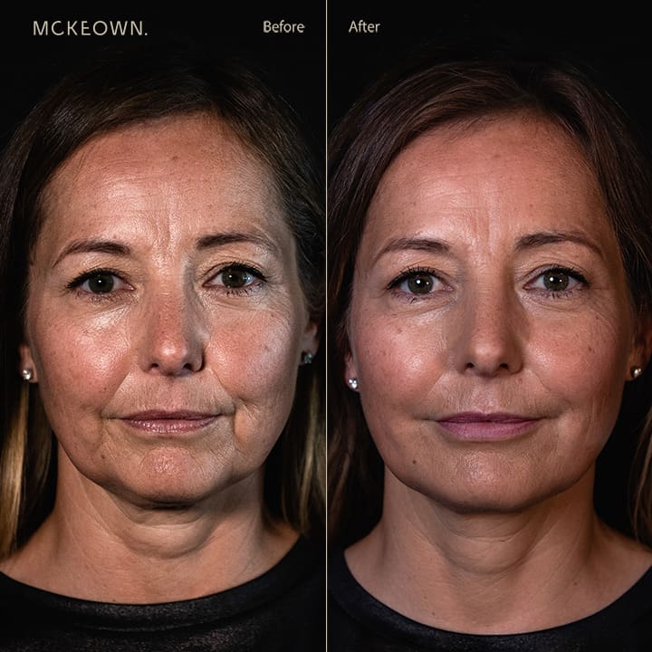 Before and after results of facial fillers including lip augmentation, addressing lip lines, marionette lines, thin lips, reduced lip volume, and lipstick/smokers' lines