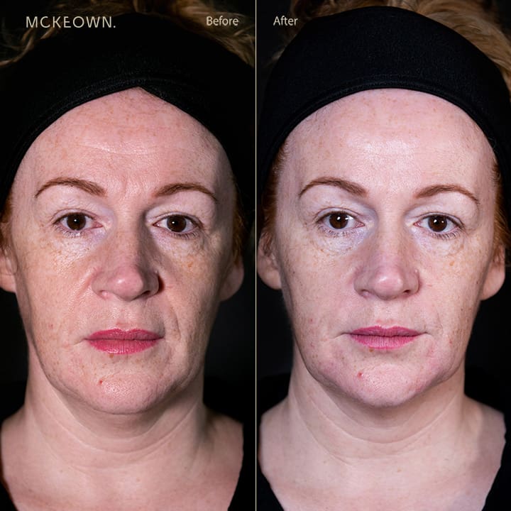 Before and after results of fillers for nose-to-mouth lines (laughter lines)