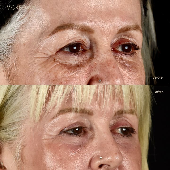 Before and after results of a laser eye lift, addressing under-eye bags