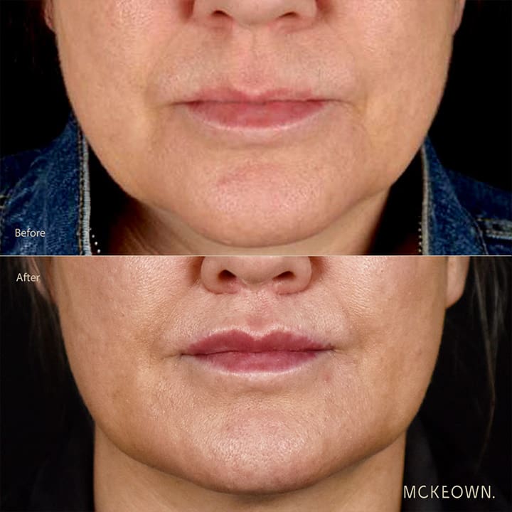 Before and after results of a lip lift, addressing a long upper lip