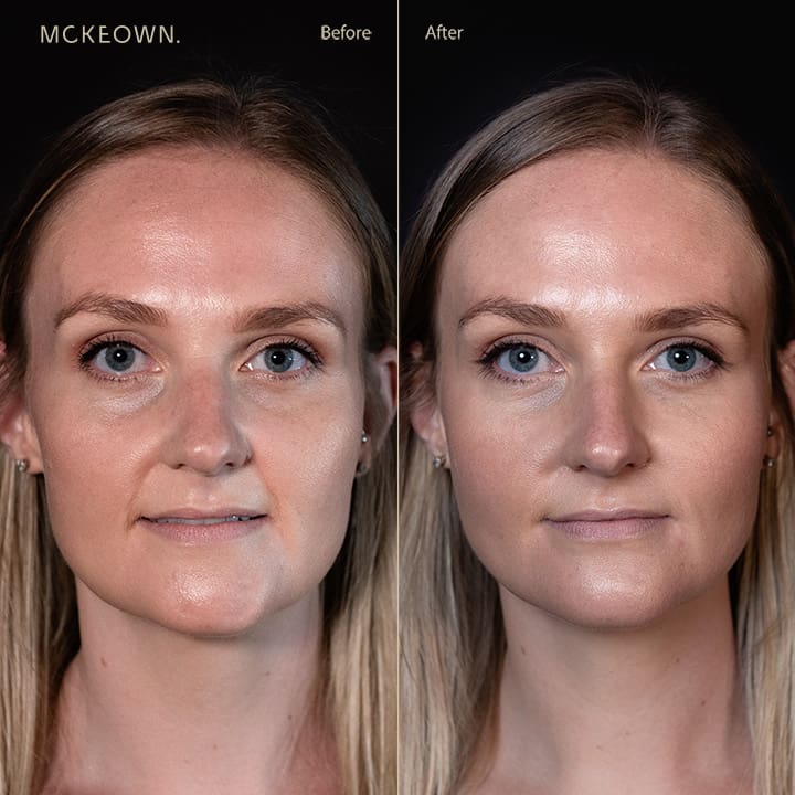 Before and after results of tear trough filler, addressing dark circles under the eyes