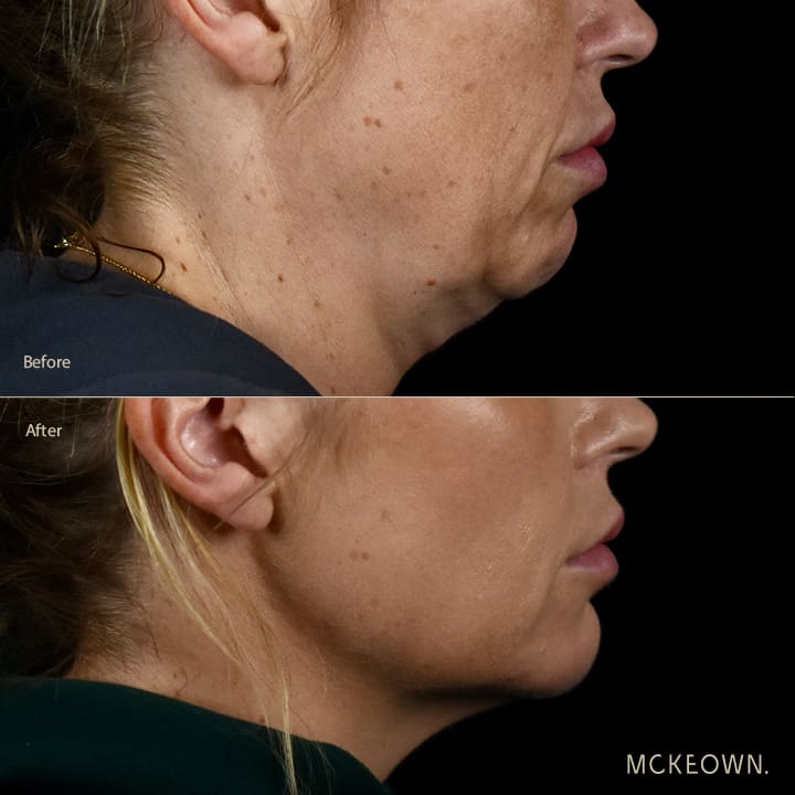 Before and after results of a volumetric facelift with chin and jaw fillers, chin augmentation, and jowl lift, addressing sagging neck and sagging jawline