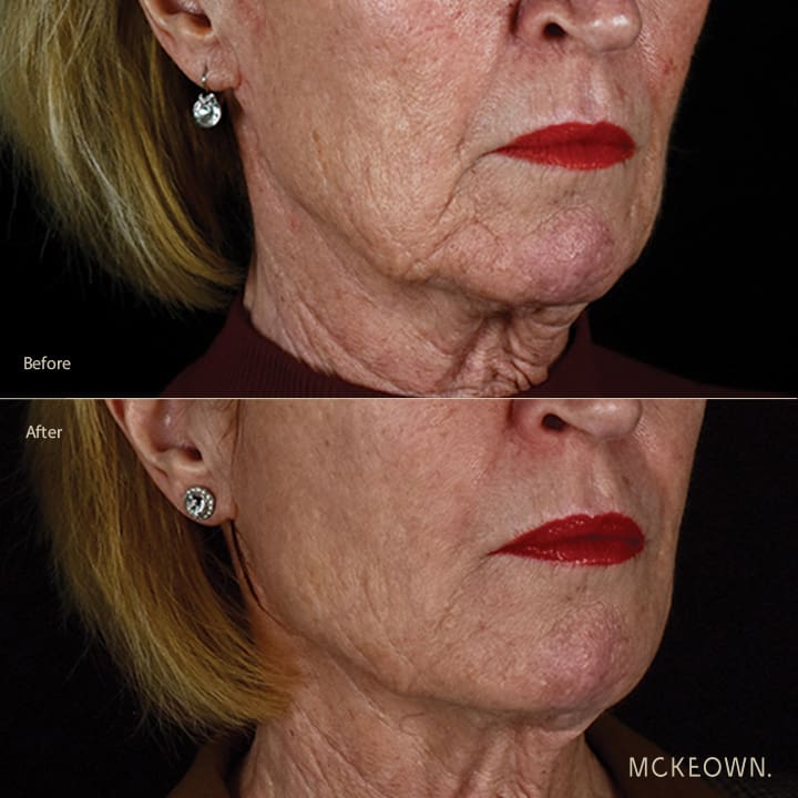 Before and after results of a volumetric facelift with fillers