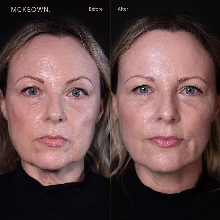 Before and after results of a volumetric facelift with jowl lift, chin augmentation, and tear trough filler, addressing sagging jawline, jowls, under-eye bags, and dark circles