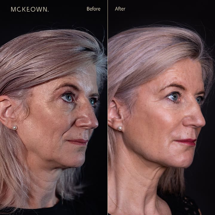 Before and after results of a volumetric facelift with jowl lift and chin, jaw, and cheek filler, addressing sagging cheeks and sagging jawline