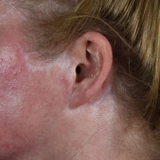 Before laser treatment to address scarring