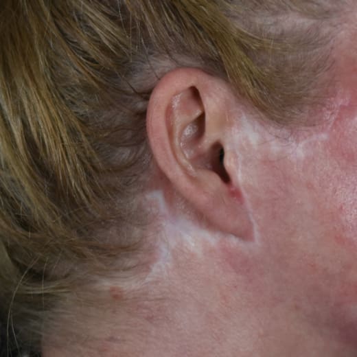 Before laser treatment to address scarring