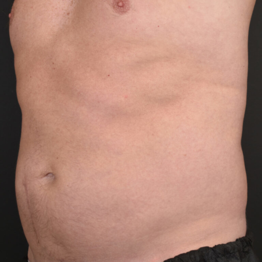 Before & After CoolSculpting, addressing male belly fat (dad bod).