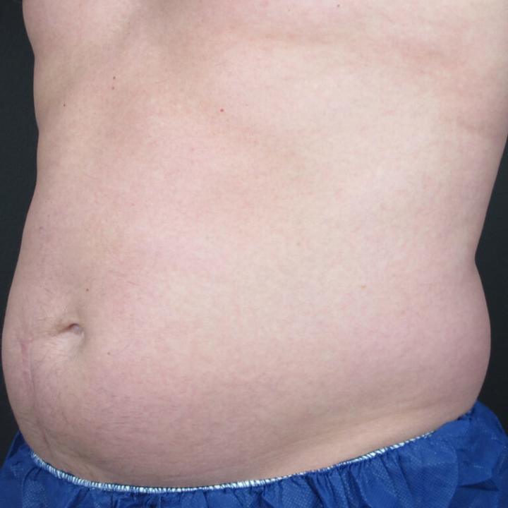 Before & After CoolSculpting, addressing male belly fat (dad bod).