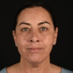 Halo laser patient after