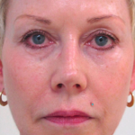Before and After Non-Surgical Facelift