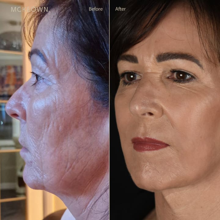 Before-and-after facial rejuvenation showing smoother skin, reduced wrinkles, and a more youthful appearance.