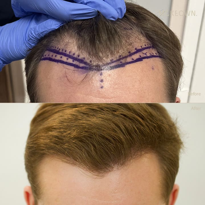 Before and after results of a hair transplant using the FUE method, addressing hairline restoration
