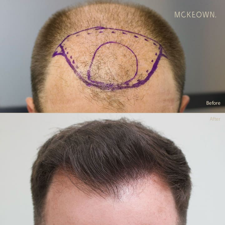 Before and after results of a hair transplant using the FUE method, addressing hairline restoration