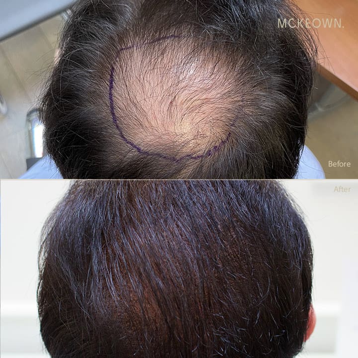 Before and after results of a hair transplant using the FUE method, addressing hairline restoration