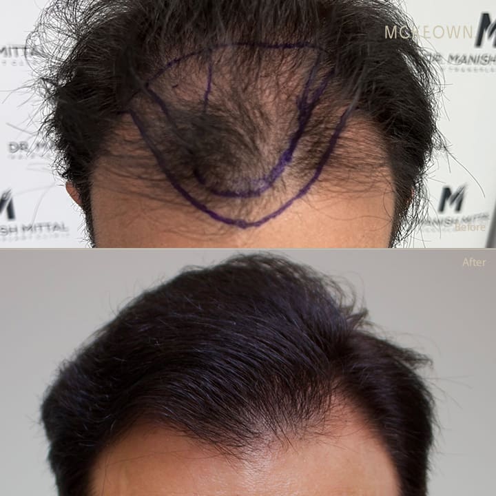 Before and after results of a hair transplant using the FUE method, addressing hairline restoration