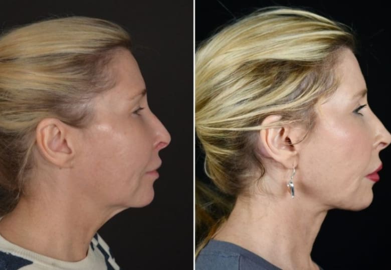 An example of a patient who underwent a deep plane face and neck lift with a deep neck reduction.