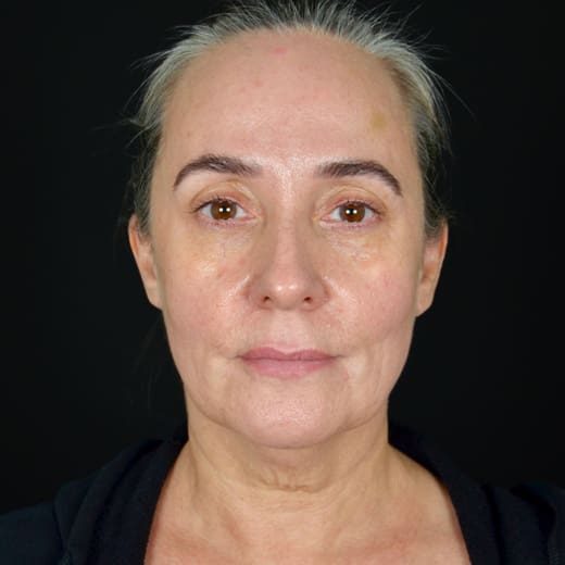 Before full facelift with deep plane face and neck lift and jowl lift, addressing sagging neck, sagging jawline, and sagging jowls