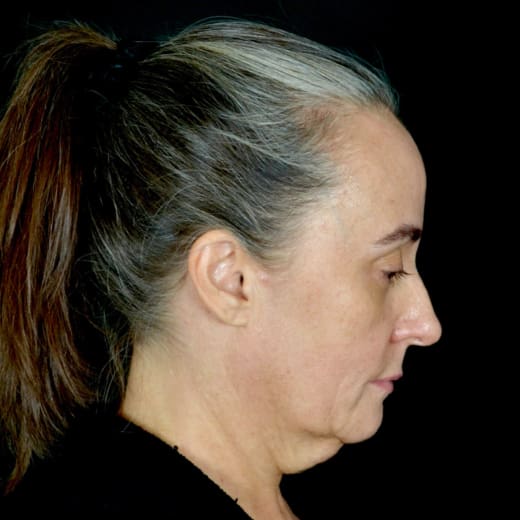 Before full facelift with deep plane face and neck lift and jowl lift, addressing sagging neck, sagging jawline, and sagging jowls