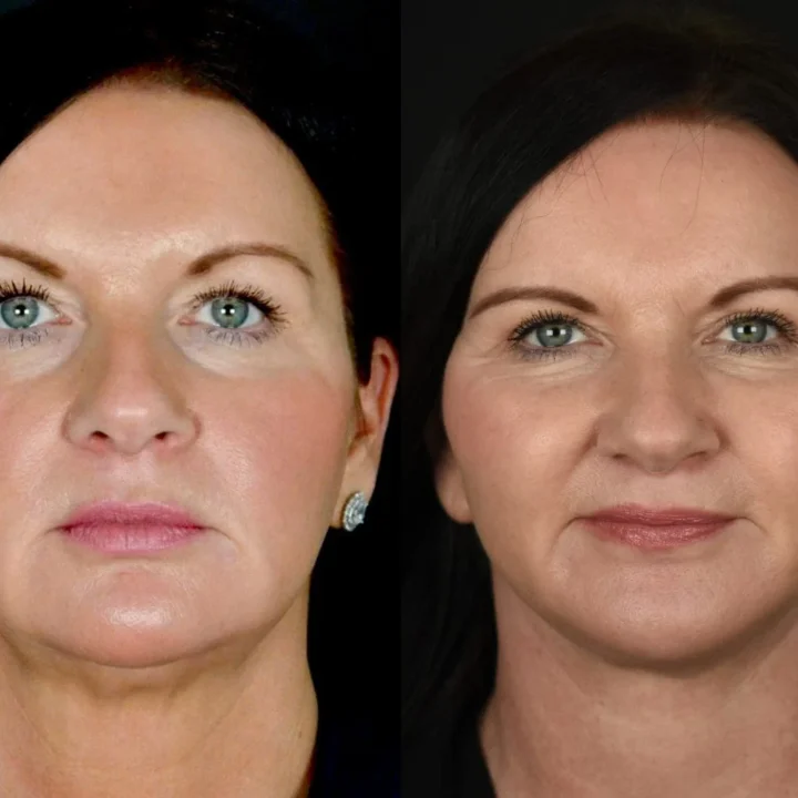 deep plane facelift before and after