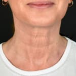 Non-surgical neck lift after
