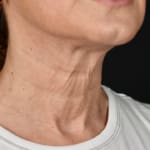 Non-surgical neck lift after