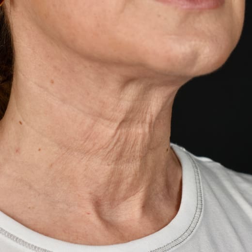 Non-surgical neck lift after