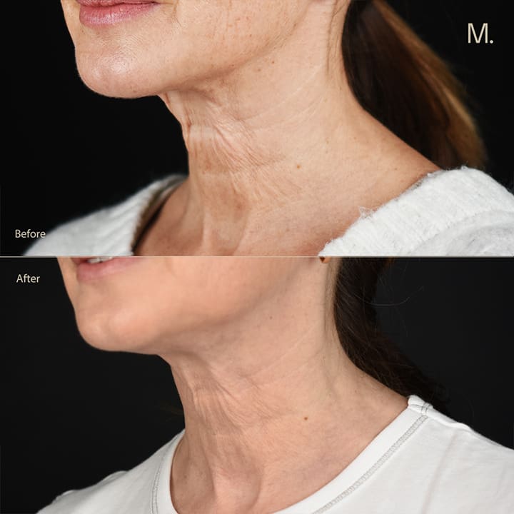Non-surgical neck lift before and after