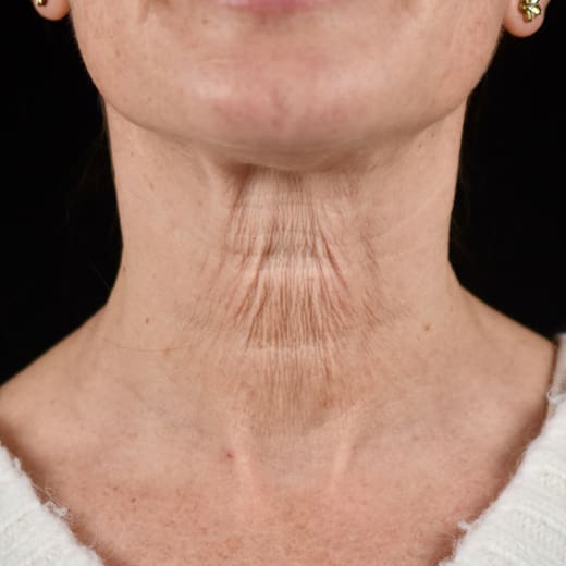 Non-surgical neck lift before
