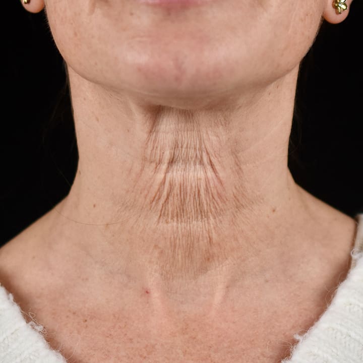 Non-surgical neck lift before