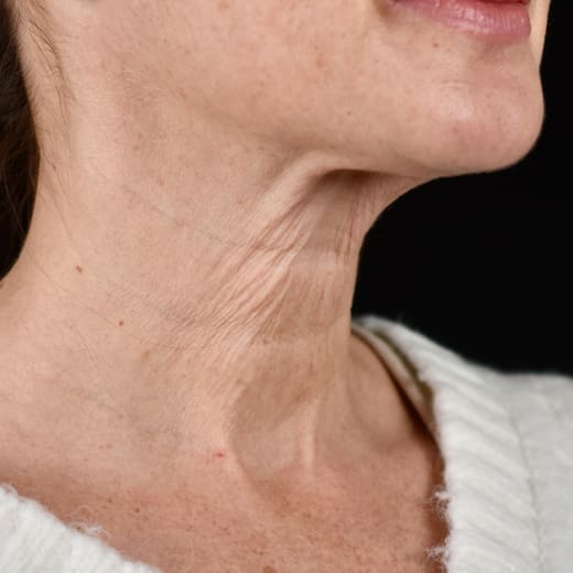 Non-surgical neck lift before