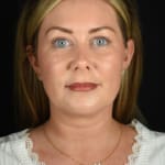 Non-surgical neck lift after