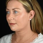 Non-surgical neck lift after