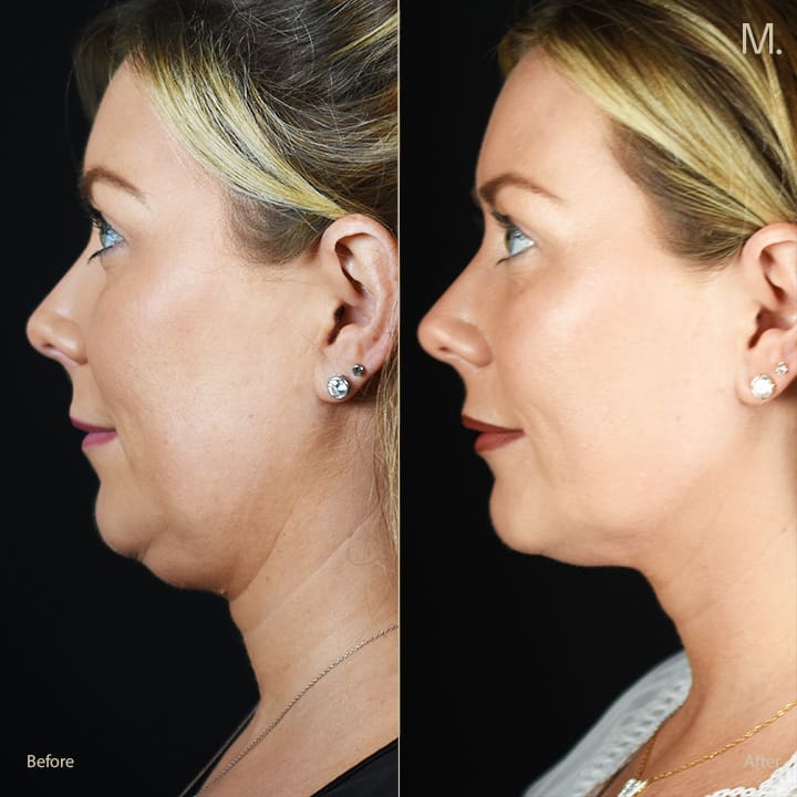 Non-surgical neck lift before and after