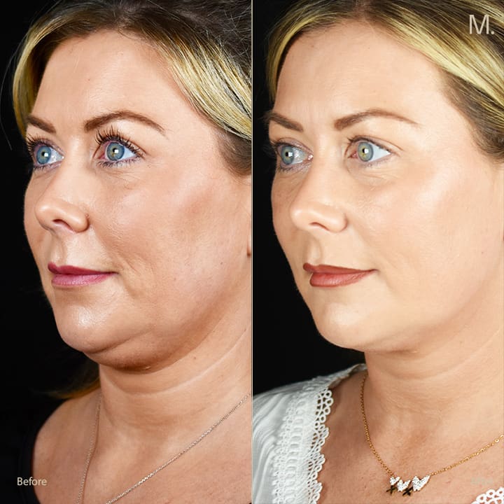 Non-surgical neck lift before and after