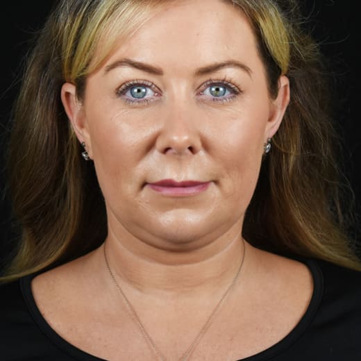 Non-surgical neck lift before